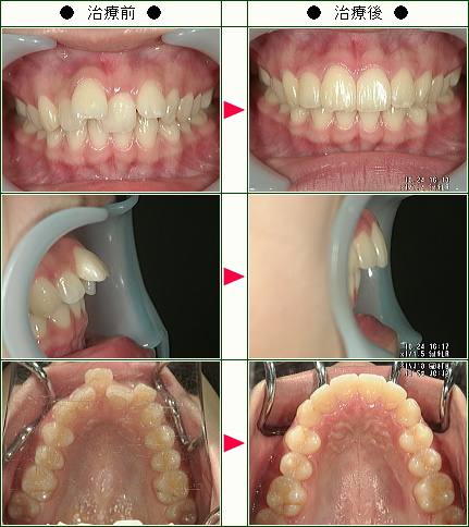 出っ歯矯正症例(１５歳　女性)