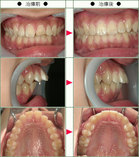 出っ歯矯正症例(１７歳　男性)
