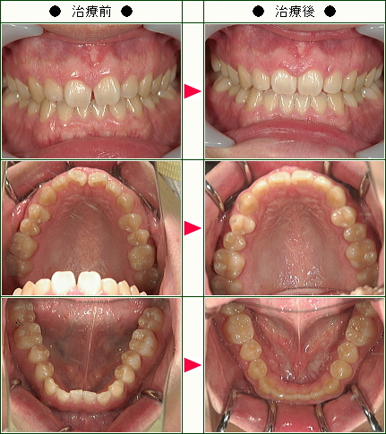 歯のデコボコ矯正症例(２４歳　男性)