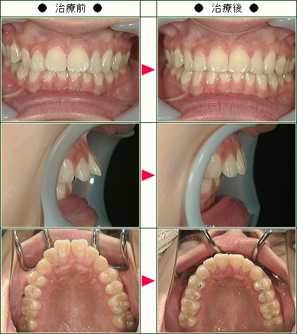 出っ歯矯正症例(２６歳　女性)