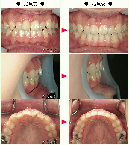 歯のデコボコ矯正症例(２９歳　女性)