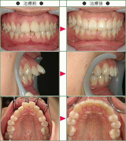 出っ歯矯正症例 上だけの症例 歳から39歳まで 1