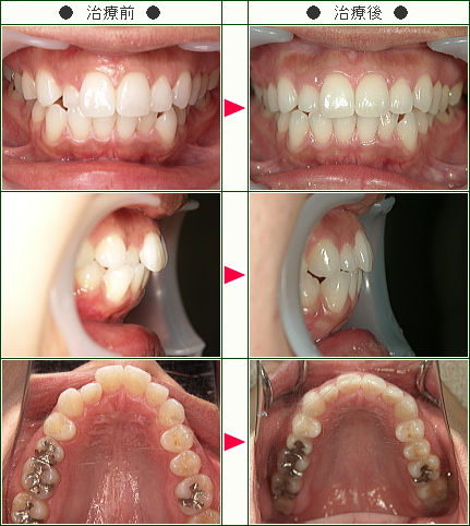 歯のデコボコ矯正症例(３０歳　女性)