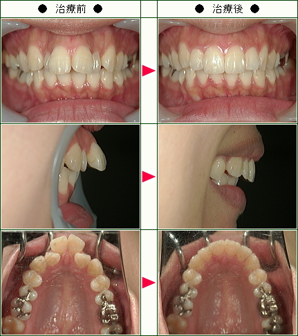 出っ歯矯正症例(３０歳　女性)