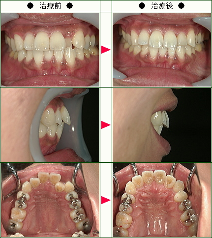 歯のデコボコ矯正症例(３３歳　女性)