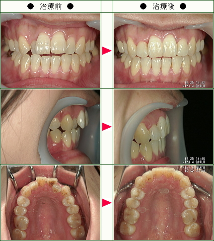 歯のデコボコ矯正症例(３４歳　女性)