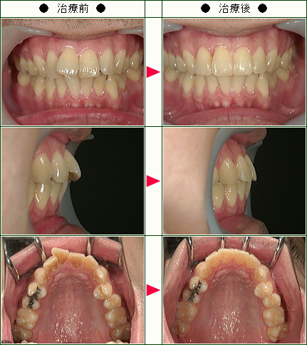 歯のデコボコ矯正症例(３５歳　男性)