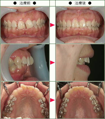 歯のデコボコ矯正症例(Ａ.Ａ様　３９歳　女性)