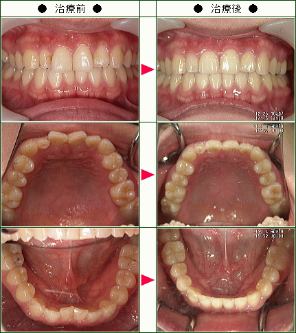 歯のデコボコ矯正症例(Ａ・Ｃ様　３０歳　女性)