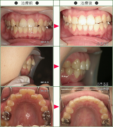 歯のデコボコ矯正症例(あっちん様　２６歳　女性)