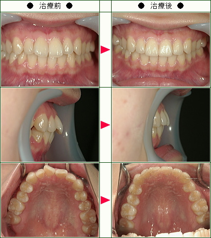 出っ歯矯正症例(Ａ.Ｆ様　２３歳　女性)