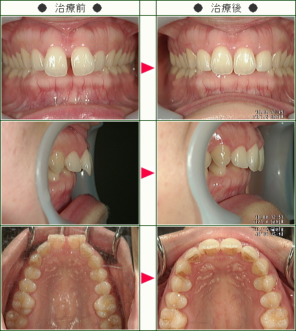 前歯のすきっ歯矯正症例(Ａ・Ｆ様　２８歳　女性)