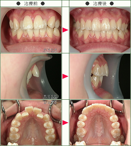 出っ歯矯正症例(Ａ・Ｈ様　１７歳　女性)
