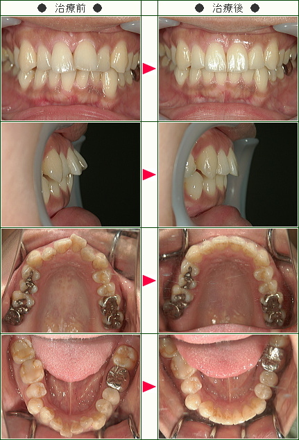 出っ歯矯正症例(Ａ．Ｈ様　３１歳　女性)