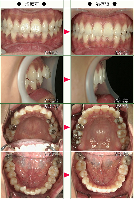 出っ歯矯正症例(あい様　２９歳　女性)