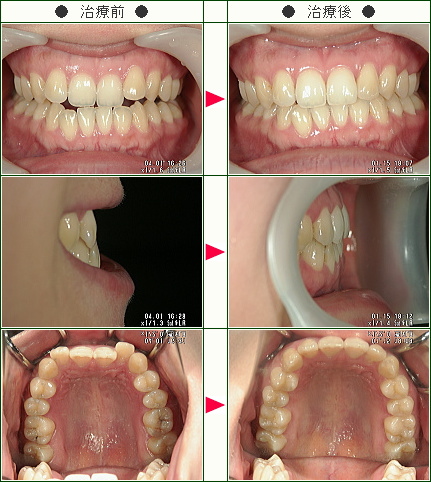 歯のデコボコ矯正症例(あい様　３１歳　女性)