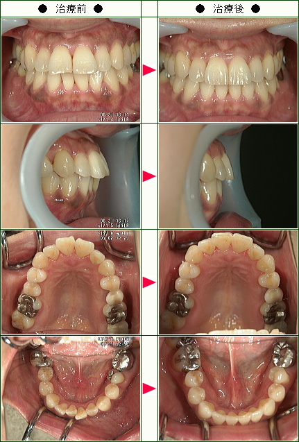 出っ歯矯正症例(Ａ.Ｉ様　５４歳　女性)
