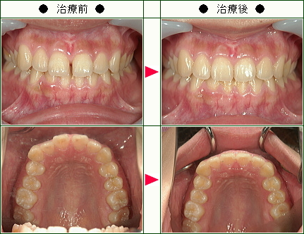 前歯のすきっ歯矯正症例(あいざわ様　２２歳　女性)