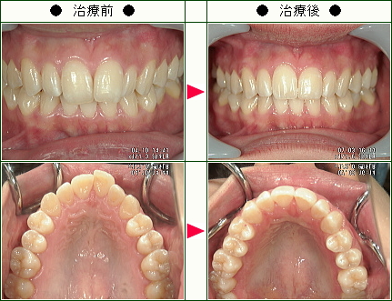 歯のデコボコ矯正症例(Ａ.Ｋ様　２０歳　女性)