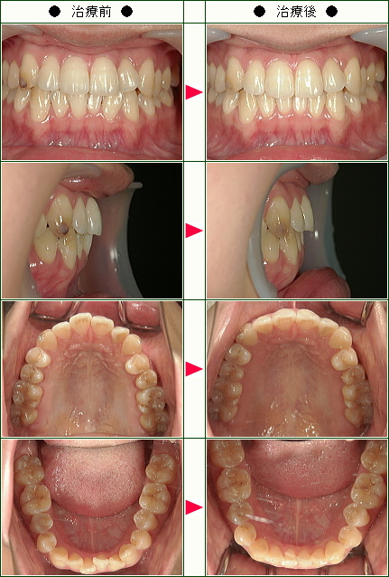 歯のデコボコ矯正症例(Ａ.Ｋ様　２２歳　女性)