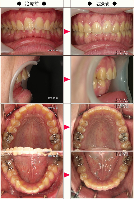 出っ歯矯正症例［Ａ・Ｋ様　２３歳　男性］