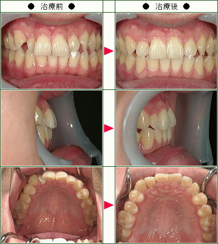 歯のデコボコ矯正症例(Ａ.Ｋ様　３１歳　男性)