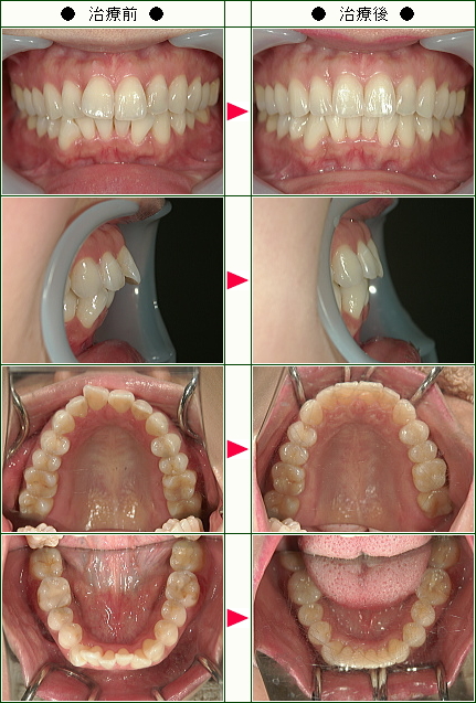 出っ歯矯正症例(Ａ.Ｋ様　３４歳　女性)