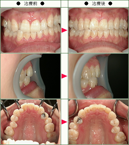 歯のデコボコ矯正症例(Ａ・Ｋ様　３６歳　女性)