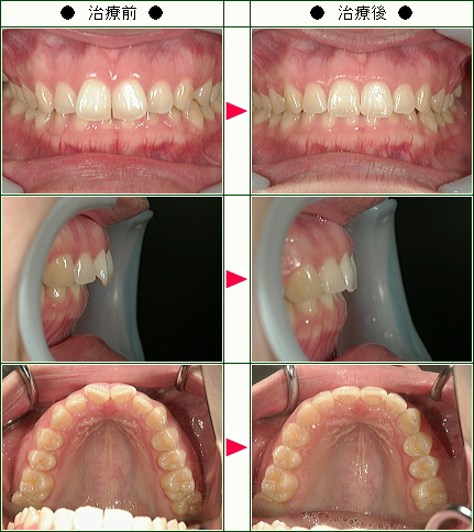 歯のデコボコ矯正症例(Ａ．Ｍ様　２４歳　女性)