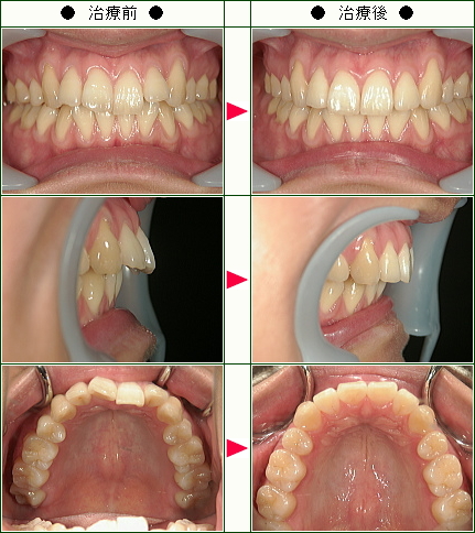 歯のデコボコ矯正症例(Ａ.Ｍ様　２５歳　女性)