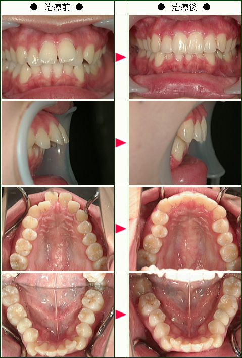 出っ歯矯正症例(Ａ・Ｍ様　２６歳　女性)
