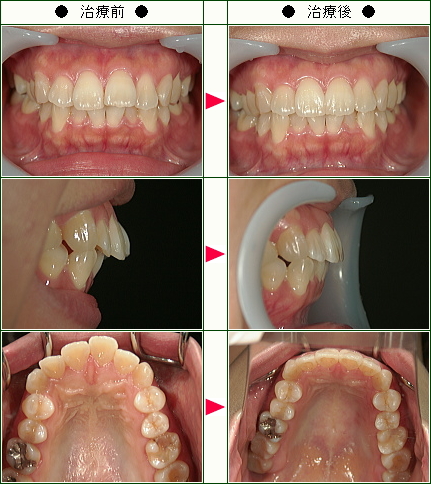 出っ歯矯正症例(Ａ.Ｍ様　２７歳　女性)