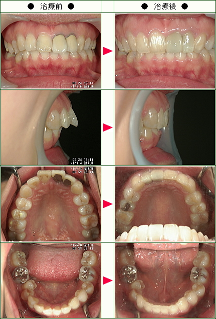 出っ歯矯正症例(Ａ.Ｍ様　３０歳　女性)