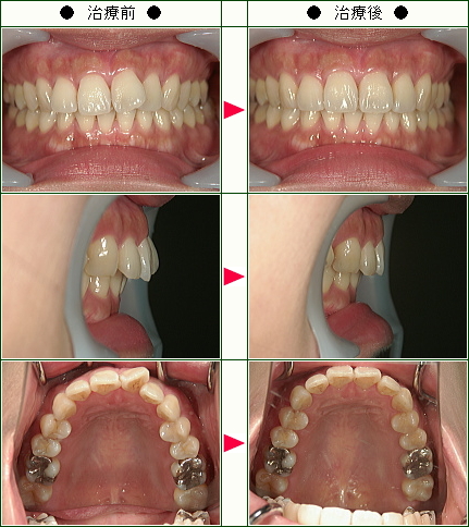 歯のデコボコ矯正症例(Ａ．Ｍ様　３５様　女性)