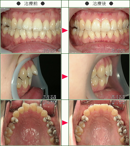 出っ歯矯正症例(Ａ・Ｍ様　３５歳　女性)