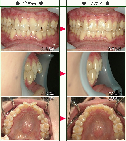 歯のデコボコ矯正症例(Ａ.Ｍ様　３６歳　女性)