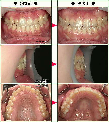 歯のデコボコ矯正症例(Ａ．Ｎ様　２０歳　女性)