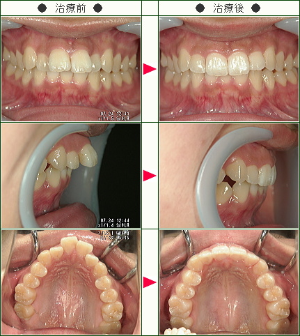 出っ歯矯正症例(Ａ.Ｎ様　２１歳　女性)