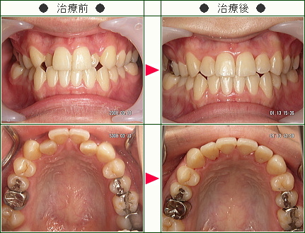 歯のデコボコ矯正症例(Ａ.Ｎ.様　２３歳　女性)