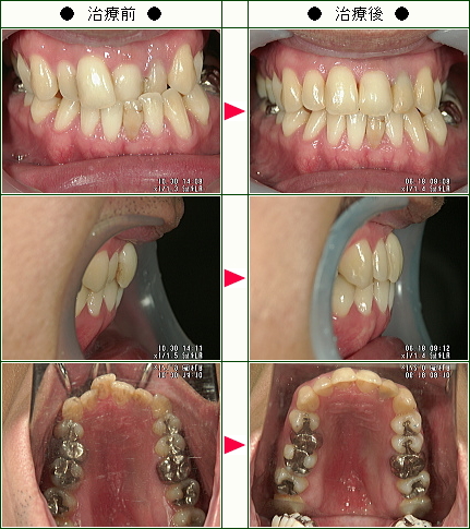 歯のデコボコ矯正症例(Ａ・Ｎ様　３３歳　男性)