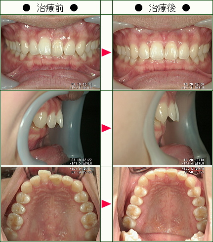 歯のデコボコ矯正症例(Ａ．Ｏ様　２４歳　女性)