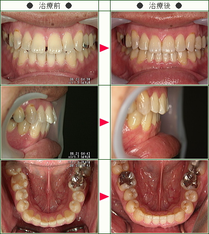 前歯のすきっ歯矯正症例(Ａ・Ｏ様　３４歳　男性)