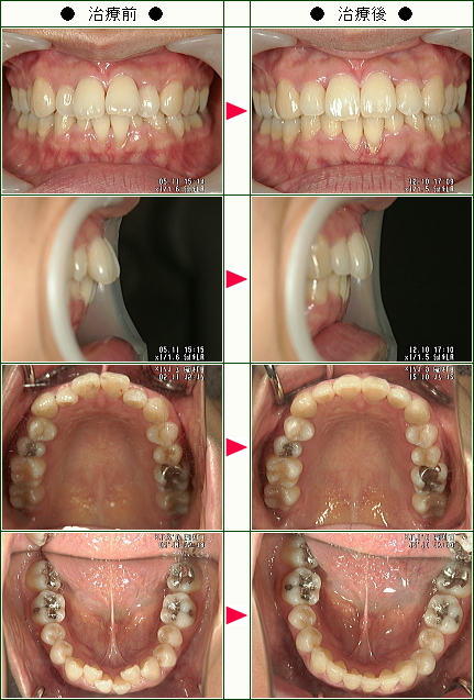 歯のデコボコ矯正症例(Ａｐｐｌｅ様　３６歳　女性)