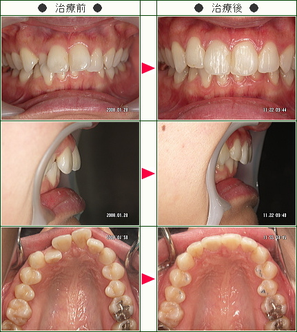 歯のデコボコ矯正症例(新井様　２７歳　女性)