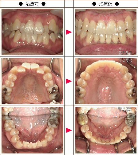 歯のデコボコ矯正症例［あらら様　３８歳　女性］