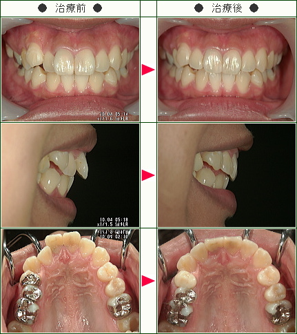 出っ歯矯正症例(Ａ.Ｓ様　１８歳　女性)