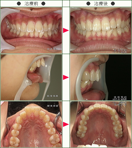 出っ歯矯正症例(Ａ．Ｓ様　１９歳　女性)