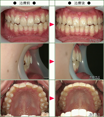 歯のデコボコ矯正症例(Ａ.Ｓ様　２１歳　女性)