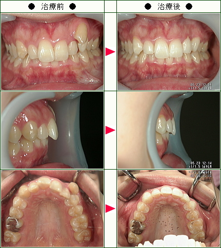 歯のデコボコ矯正症例(Ａ.Ｓ様　２４歳　女性)