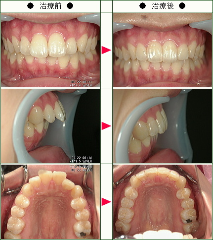 出っ歯矯正症例(Ａ.Ｓ様　２５歳　女性)
